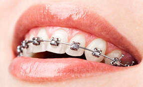 ortodoncia clinica dental las palmas verodent